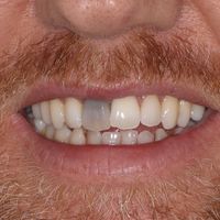 Dental Crown - Smile 1 before